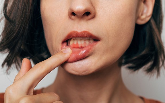Woman with gum irritation