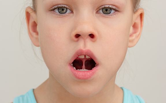 Young girl with a tongue-tie