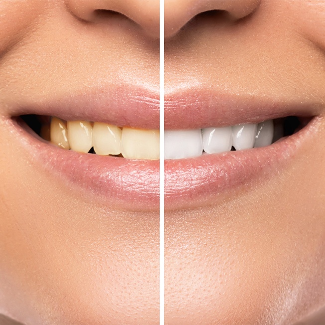 Smile before and after teeth whitening